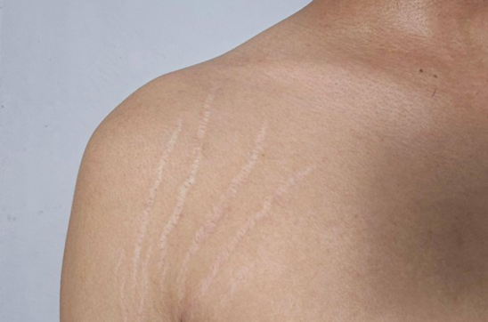 Boxcar Scars: Causes, Treatment & Prevention Tips