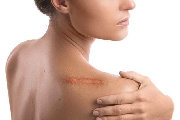 Scar Tissue Meaning