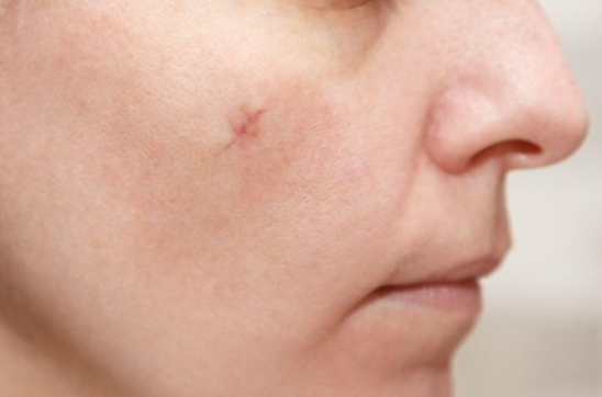 Does Mole Removal Leave a Scar? What to Expect After the Procedure