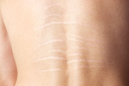 Stretch Marks on the Back